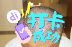 -大麦微针植发全国连锁