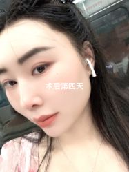 体验后-碧莲盛·不剃发植发