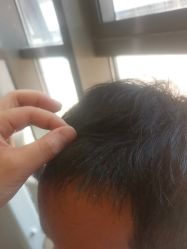 -碧莲盛·不剃发植发