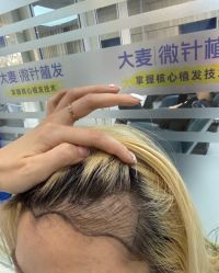 -大麦微针植发全国连锁