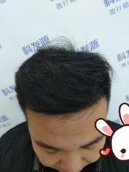 -大麦微针植发丨全国连锁