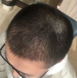 -大麦微针植发丨全国连锁