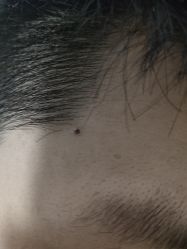 -痣缘宫