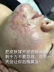 -瑶芳清颜草本祛痘