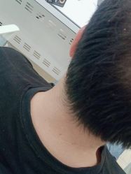 -碧莲盛·不剃发植发