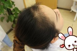 点击看大图 -大麦微针植发丨全国连锁