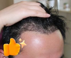 -大麦微针植发丨全国连锁