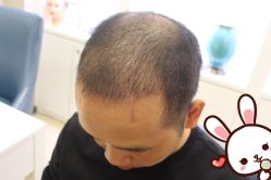 点击看大图 -大麦微针植发丨全国连锁