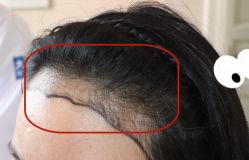 -大麦微针植发全国连锁