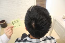 点击看大图 -大麦微针植发丨全国连锁