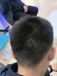 体验后-雍禾植发全国连锁