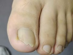 -祖传修脚甲沟炎灰指甲鸡眼