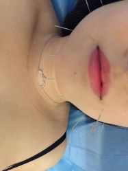 -肥三针腧穴瘦身馆