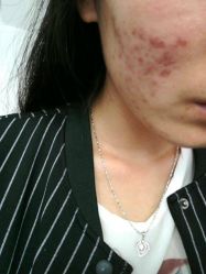 -清颜专业祛痘连锁店