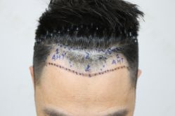 -熙朵美学植发·连锁品牌