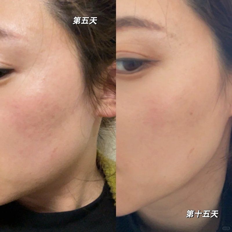 黄金微针前后对比