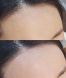 -薇兰专业脱毛连锁机构