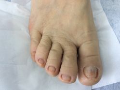 -德哥灰指甲脚气甲沟炎跖疣护理