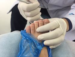 -派恩宜灰指甲·甲沟炎·鸡眼康护