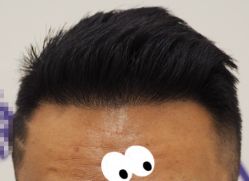 -大麦微针植发全国连锁