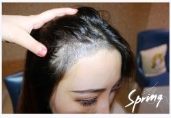 点击看大图 体验后-大麦微针植发全国连锁