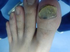 -Andrew指甲专科灰指甲·甲沟炎矫正·3D步态矫形鞋垫定制(上海法华镇路旗舰店)