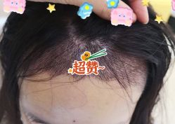 -大麦微针植发全国连锁