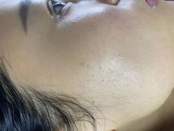 -爱莎扁平疣·汗管瘤·斑痣中心