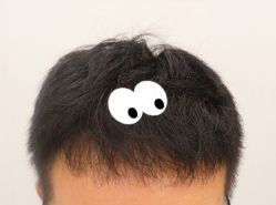 -大麦微针植发全国连锁