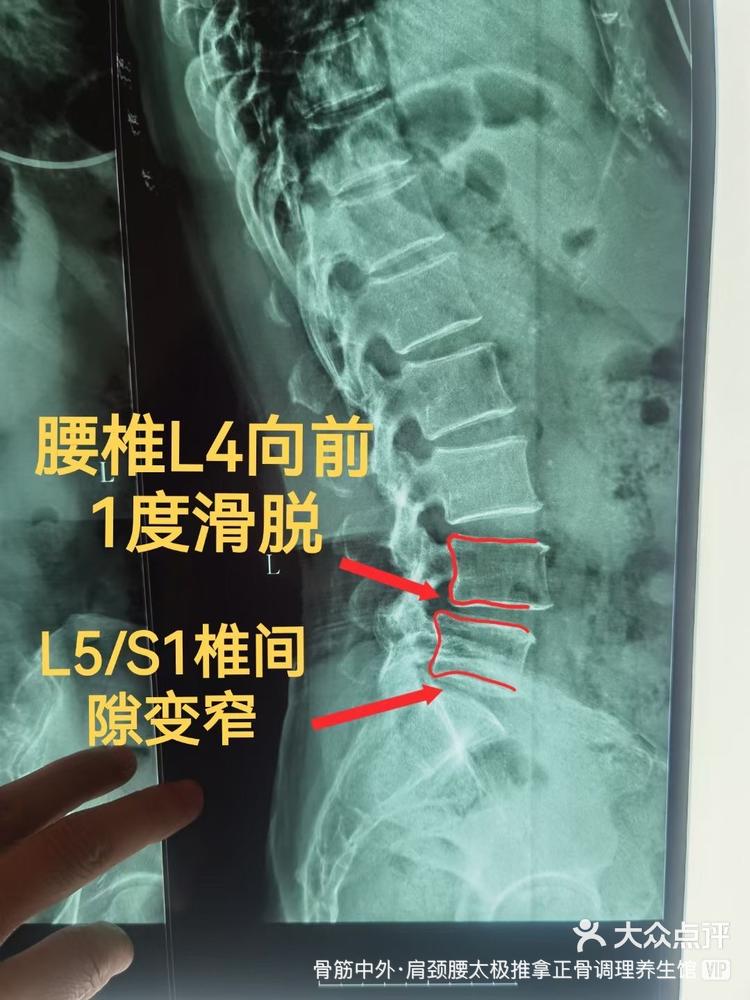 正常腰椎ct图图片