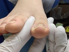 -Andrew指甲专科灰指甲·甲沟炎矫正·3D步态矫形鞋垫定制(上海法华镇路旗舰店)