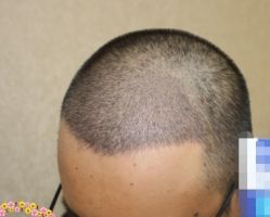 -大麦微针植发丨全国连锁