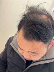 -大麦微针植发丨全国连锁