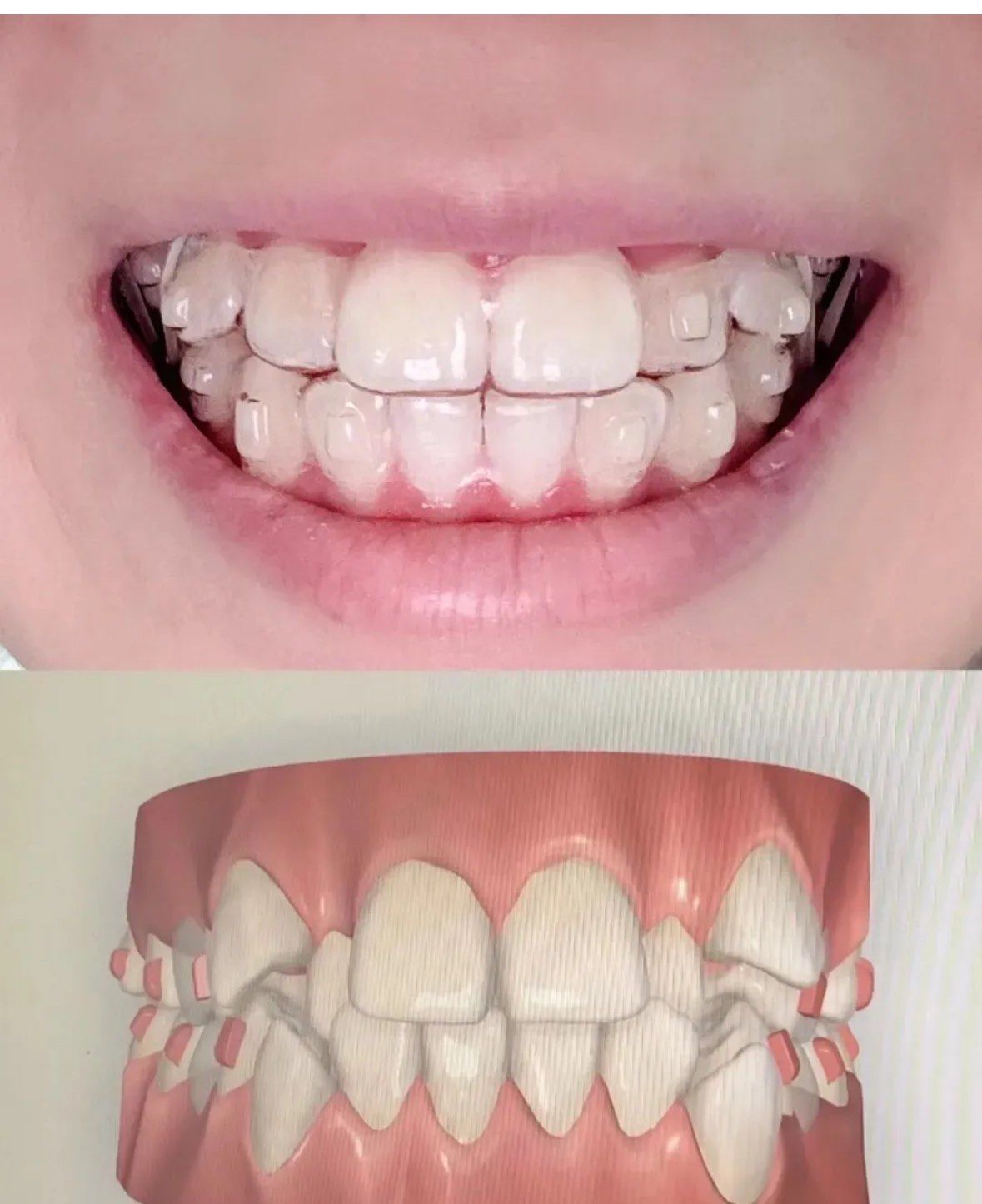 相信在不久的将来,我会拥有一口整齐美丽的牙齿