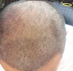 -大麦微针植发丨全国连锁