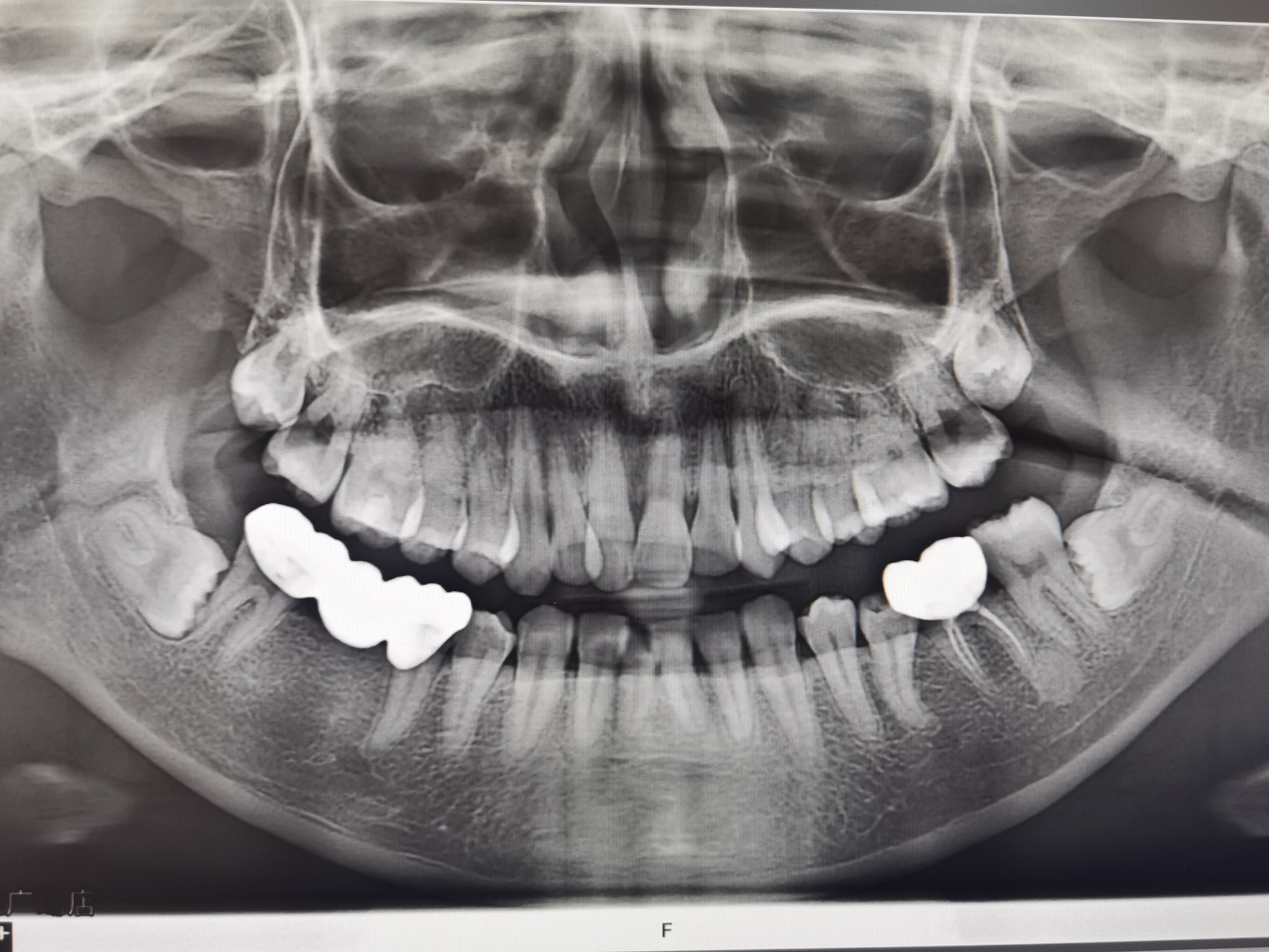 阻生智齿x光片图片