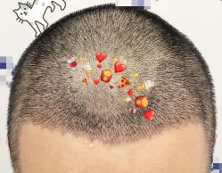 -大麦微针植发全国连锁