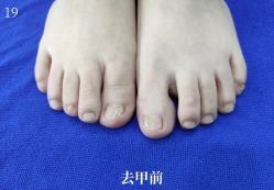 -德哥灰指甲脚气甲沟炎跖疣护理