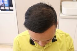 -大麦微针植发丨全国连锁