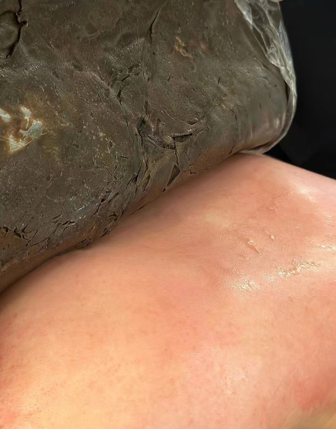 背部泥灸的好处