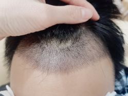 点击看大图 -碧莲盛·不剃发植发