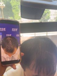 -碧莲盛·不剃发植发