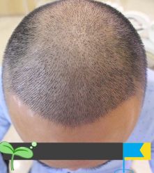 -大麦微针植发丨全国连锁