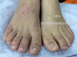 -德哥灰指甲脚气甲沟炎跖疣护理