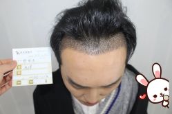 -大麦微针植发丨全国连锁