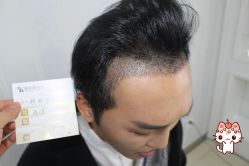 -大麦微针植发丨全国连锁