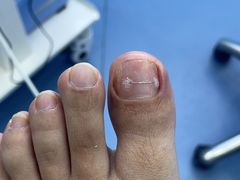 -Andrew指甲专科灰指甲·甲沟炎矫正·3D步态矫形鞋垫定制(浦三路店)