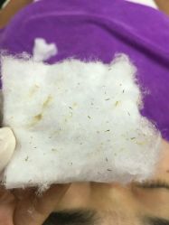 点击看大图 治疗效果-蕾特恩专业祛痘国际连锁