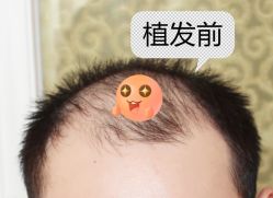 -大麦微针植发全国连锁