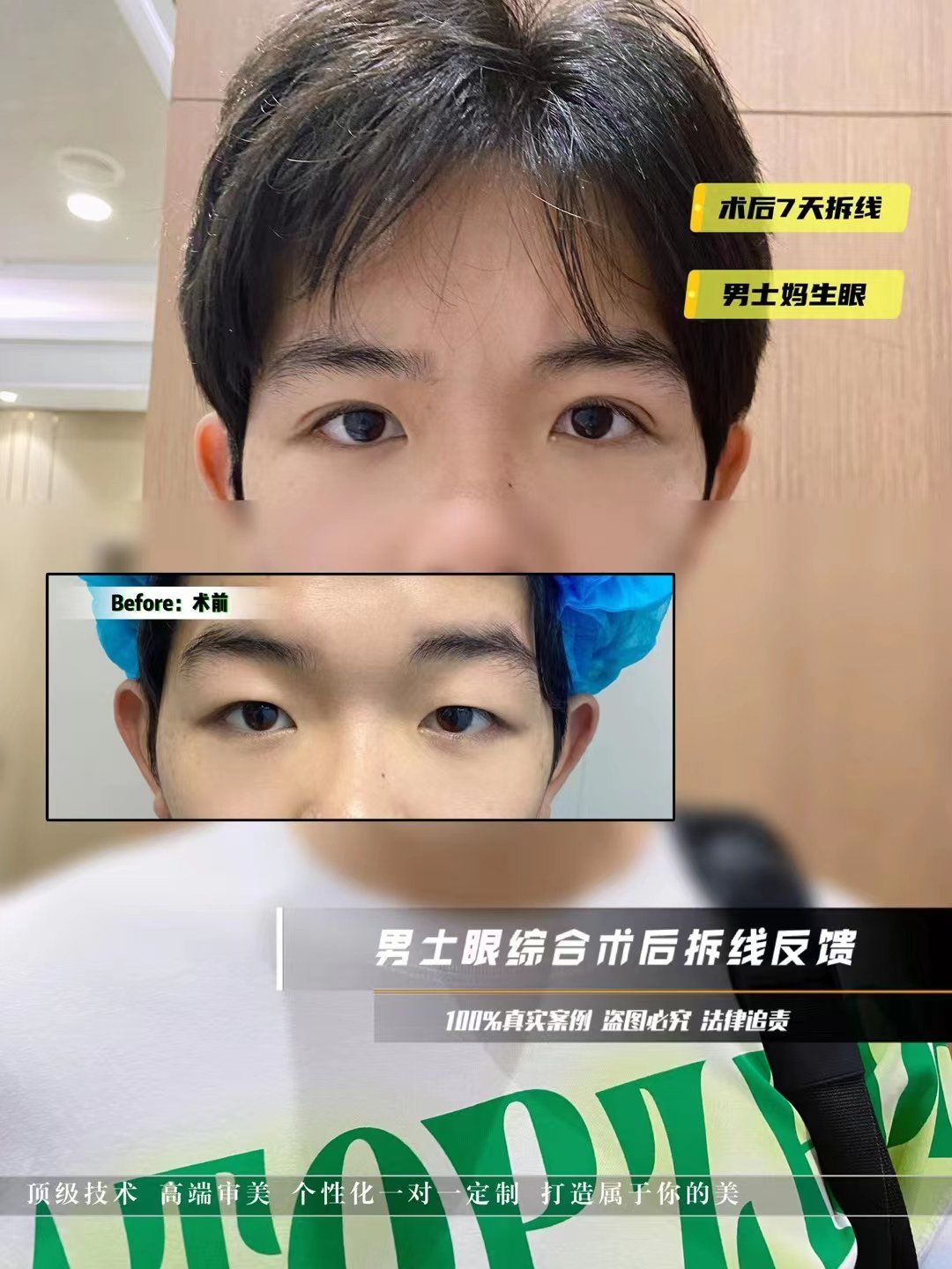 男士眼综合自然款